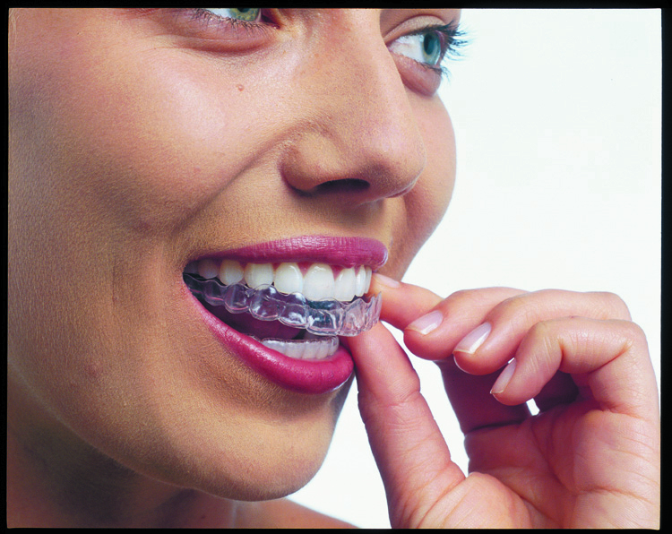 Inserting aligners 2.jpg